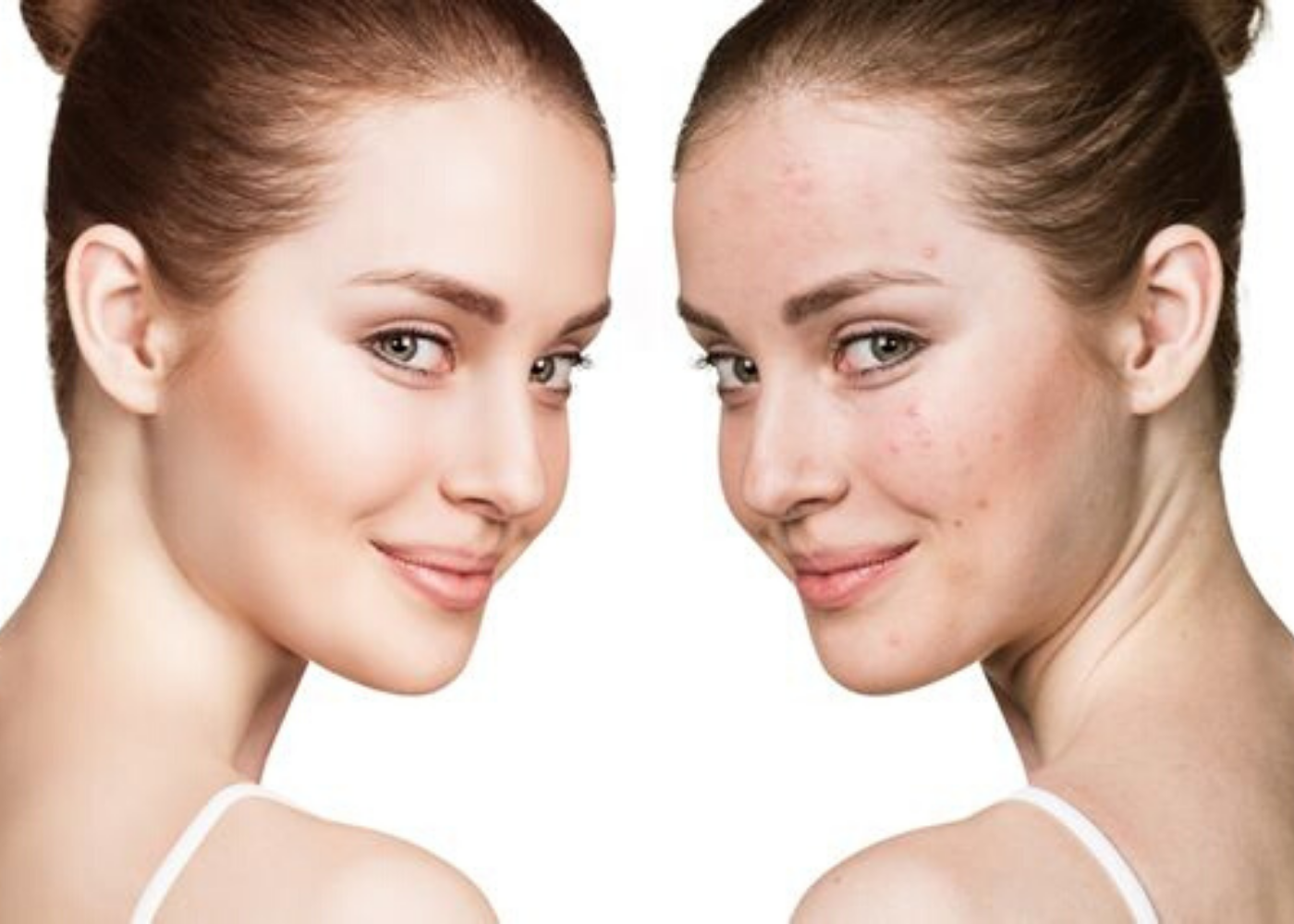 acne treatment ferrara dermatology