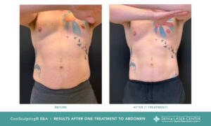 Coolsculpting Before and After Male