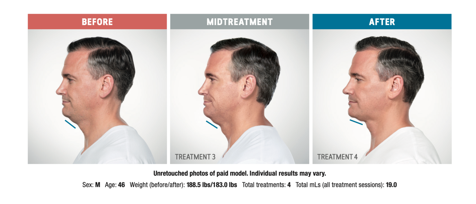 Kybella Ferrara Dermatology