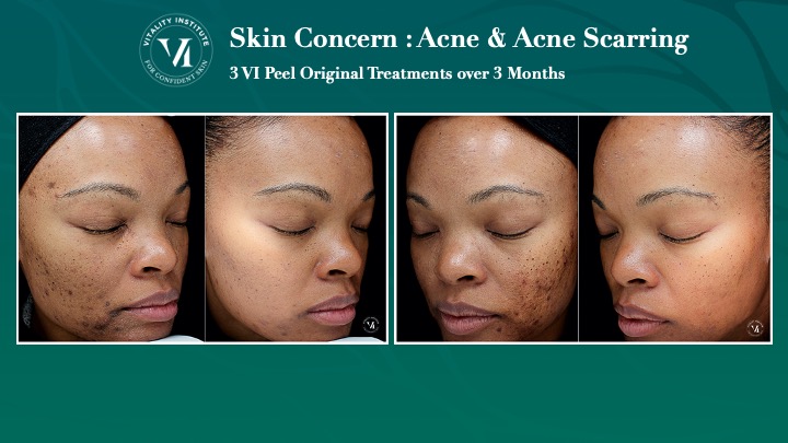 VI Peel Acne Before and After