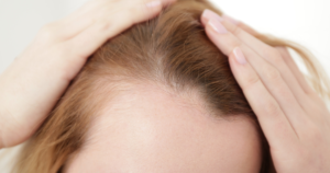 Scalp experiencing hair loss
