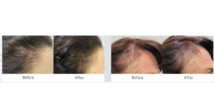Viviscal Hair Loss Product Before and After Images