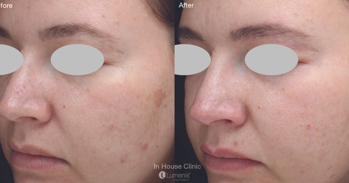 Before and After Pic IPL Laser Facial Treatment